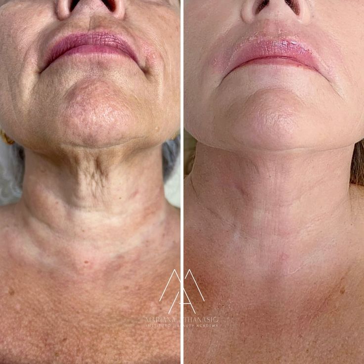 🐝 Botox Bee Venom Anti-Aging Cream