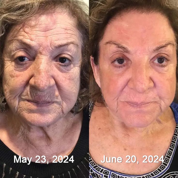 🐝 Botox Bee Venom Anti-Aging Cream