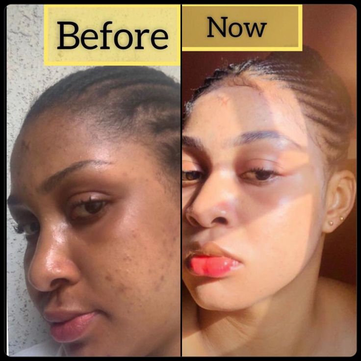 Anua Rice Glow Combo — The Complete Korean Glass Skin Routine